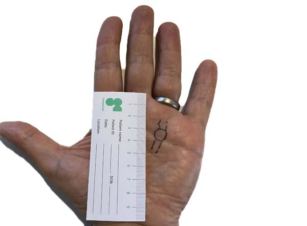 A left hand with a silver ring on the ring finger displays a small black ink drawing and a ruler for scale across the palm, possibly illustrating signs of Dupuytrens disease. The background is white.