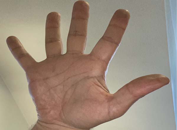 A close-up of an outstretched human hand with fingers spread wide, photographed against a light background with part of a window visible on the right side—ideal for illustrating early Dupuytren’s contracture symptoms.
