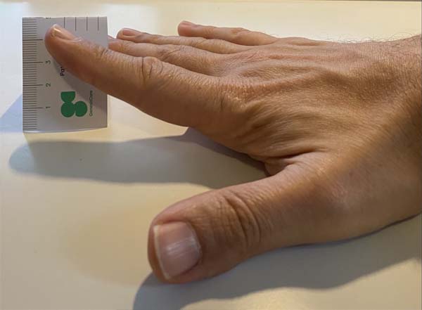 A hand rests flat on a surface with fingers extended—commonly checked in cases of Dupuytrens contracture disease. A ruler is held perpendicular to the pinky, measuring its length. The scene is well-lit and focuses on the hand and ruler.