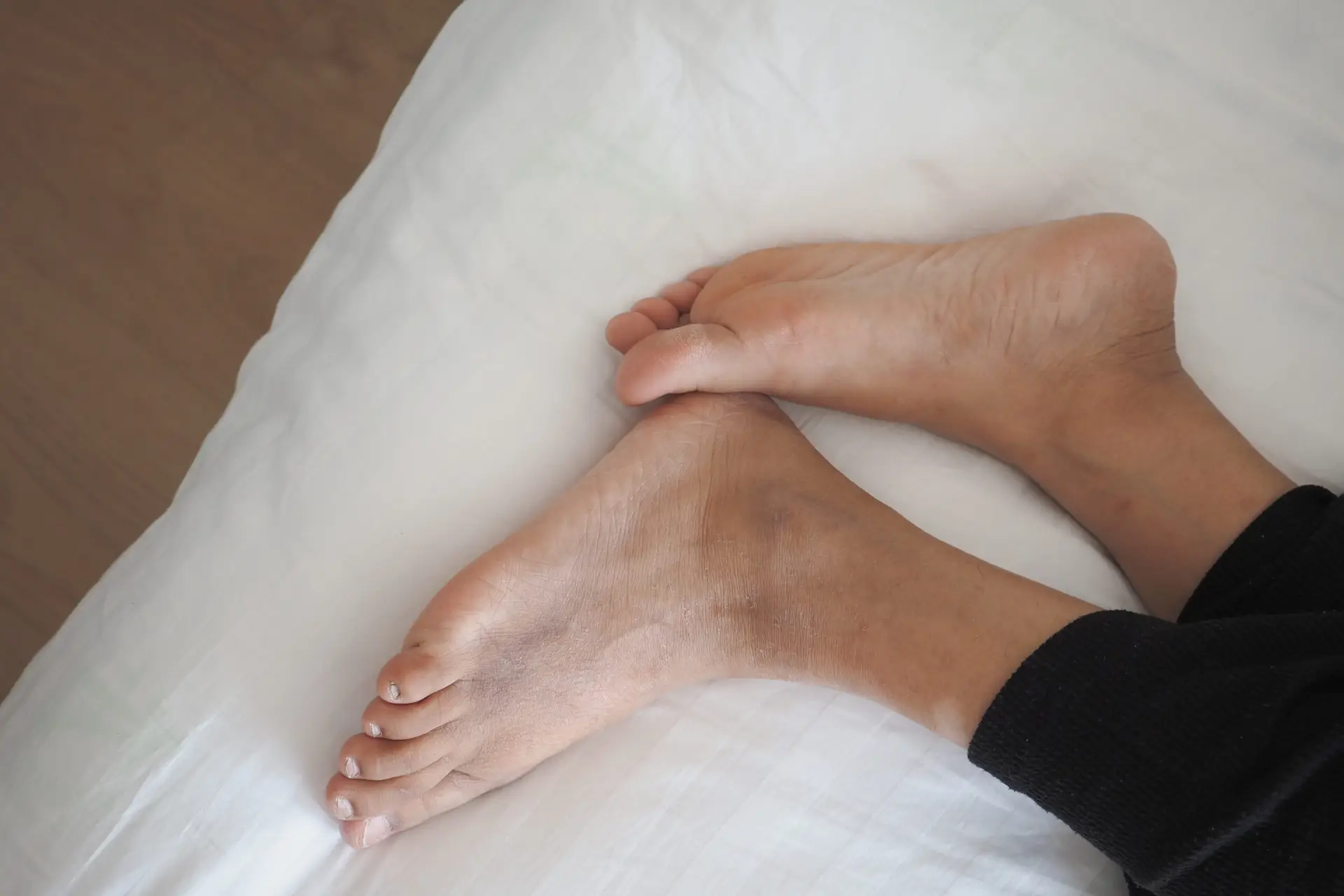 Two bare feet with dry, slightly discolored skin—possibly suggestive of ledderhose disease—rest on a white sheet. The person is wearing black pants, and their relaxed feet are crossed at the ankles.