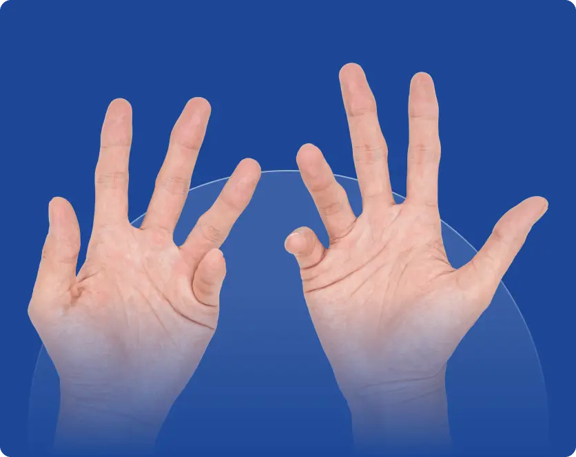 Two open hands with palms facing forward against a blue background. The left pinky and right ring finger are bent abnormally, a sign of Dupuytrens disease, which may require dupuytrens contracture treatment UK.
