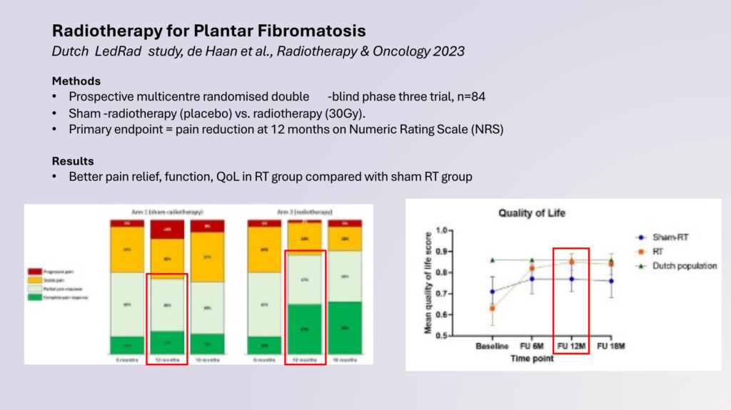 New Trial: Radiotherapy is proven to be effective in Ledderhose disease