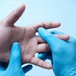 Dupuytren’s Radiotherapy