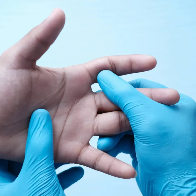 Dupuytren’s Radiotherapy