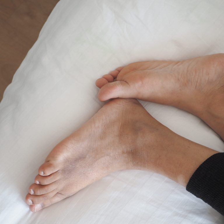 Two bare feet with dry, slightly discolored skin—possibly suggestive of ledderhose disease—rest on a white sheet. The person is wearing black pants, and their relaxed feet are crossed at the ankles.