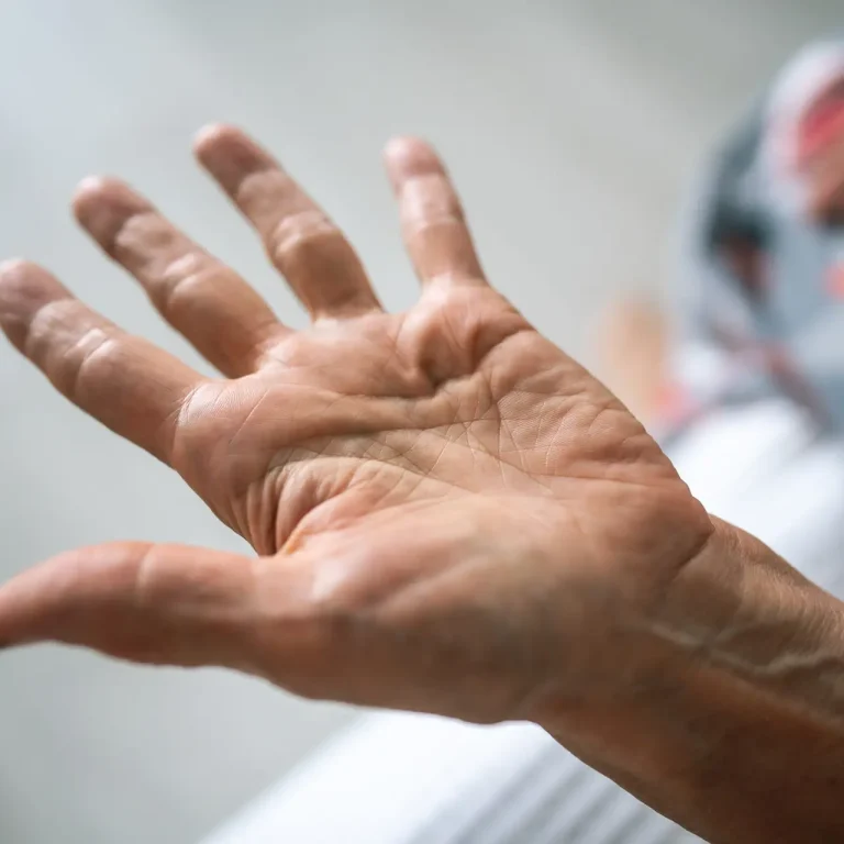 Dupuytren contracture and bulge on palm, closeup. Mature woman hand with dense node under ring finger. Female encounters difficulty in palm, finger movement, hand tendon condition, dense node